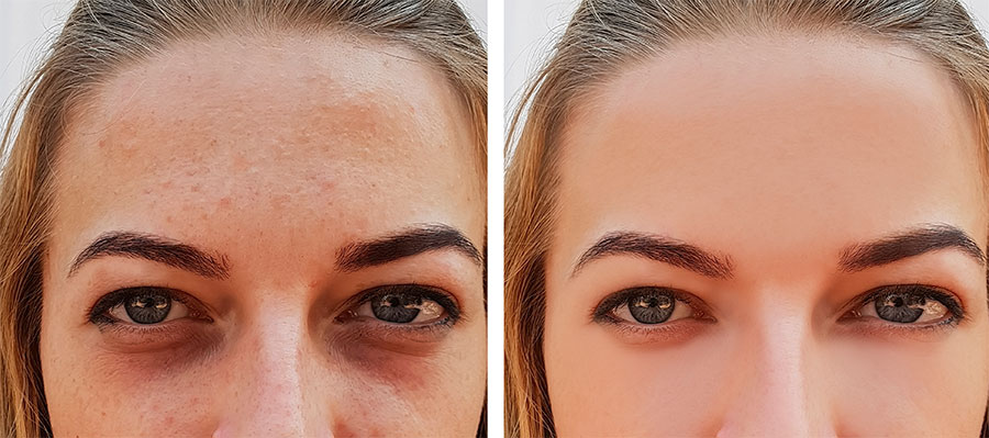 Ipl foto facial